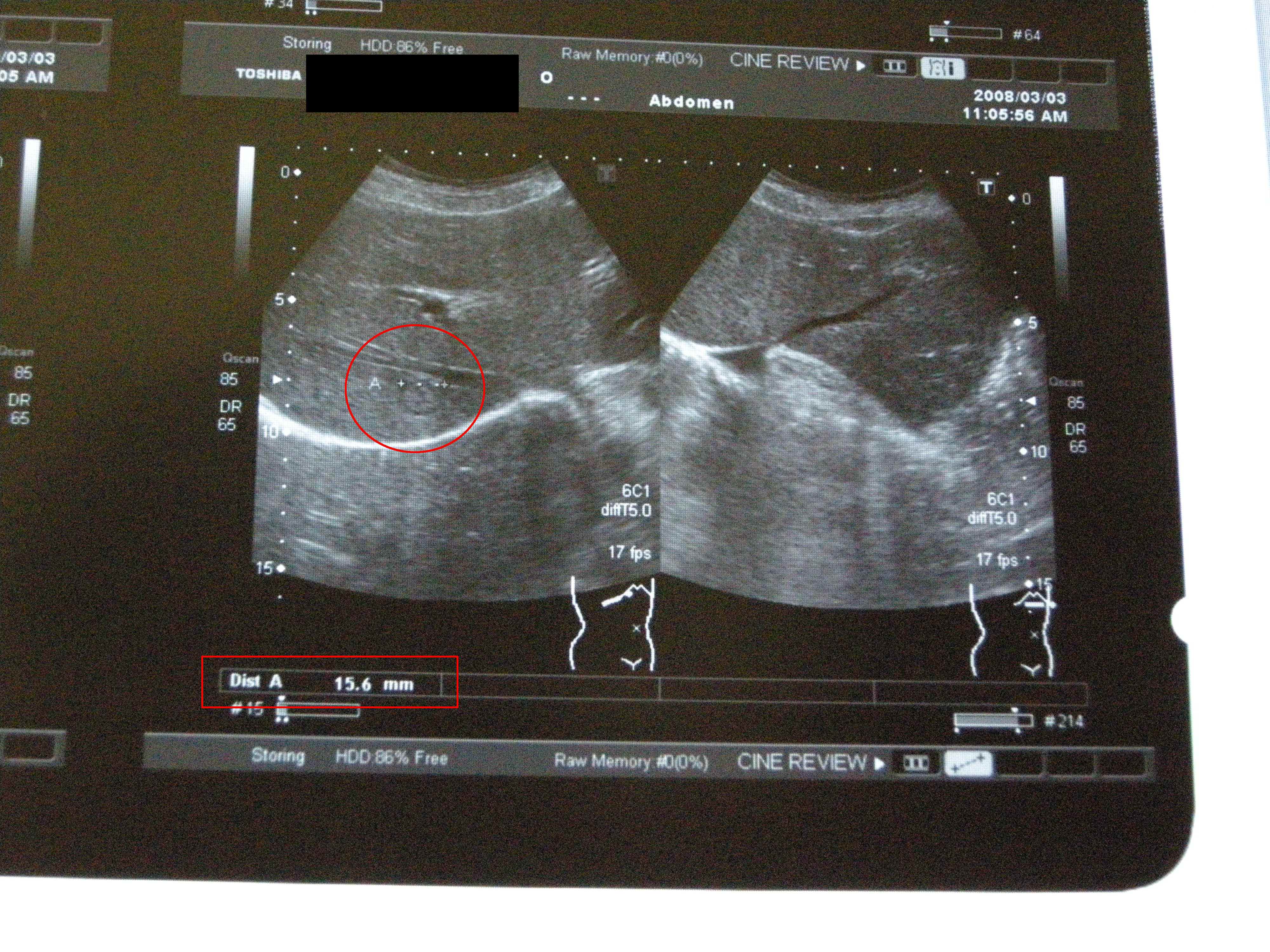 気功体験談：肝臓癌患者のエコー検査画像（発症時）