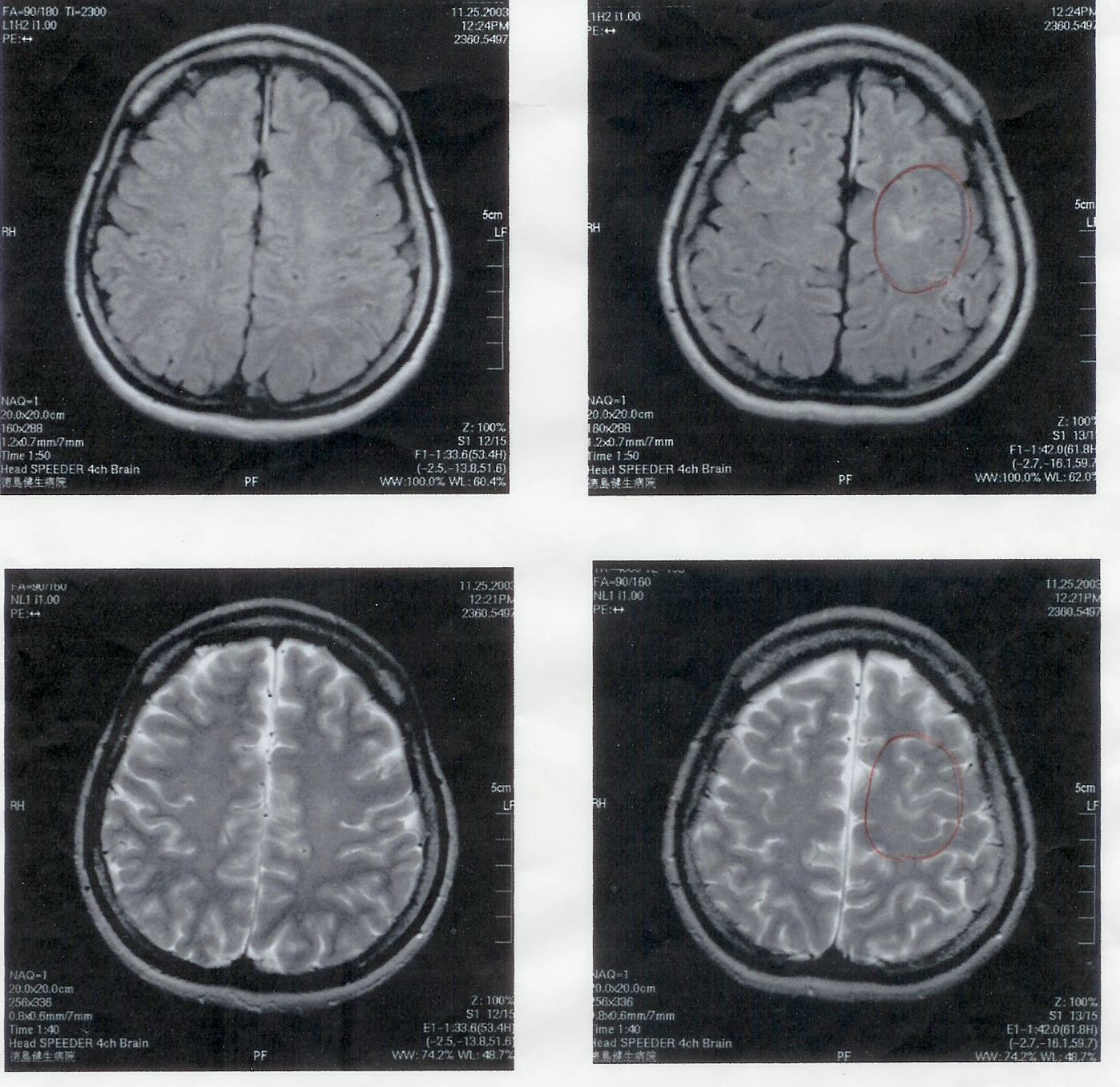 気功論文：脳腫瘍患者のMRI検査画像１